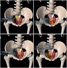 Image result for Pelvic Floor Dysfunction