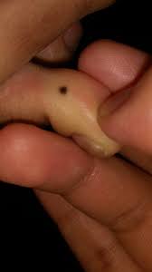 According to the american cancer society, just over 100,000 new cases of skin cancer are diagnosed in the united states each year. Just Noticed A New Mole On My Toe Is This A Cause For Concern Melanoma