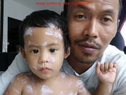 5 Gambar Anak Ketiga Shuib Siti Sarah Kena Demam Campak Kesian Anak Didi Ni Kena Campak Pulak Doakan Cepat Elok Ye Campak Anak Saya Ni C Gambar Anak