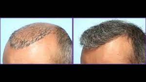 It also regenerates skin collagen and accelerates the healing of damaged and wounded skin cells. Can We Regrow Lost Hair How To Use Emu Oil For Hair Loss Youtube