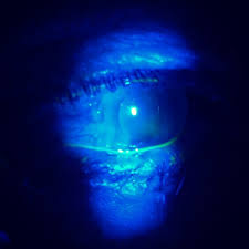 Image result for Seidel Test