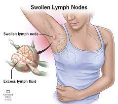 Cancer cells can break away from the primary cancer and travel through the lymphatic system to lymph. Swollen Lymph Nodes Lymphadenopathy