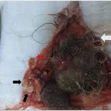It is an example of what is called a germ cell tumor. Pdf Ovarian Tumor With Mature Teratoma With Squamous Differentiation In A Postmenopausal Female