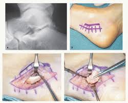 Os Trigonum Surgery Musculoskeletal Key