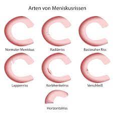 Meniskus Op Verfahren Und Spezialisten Leading Medicine Guide