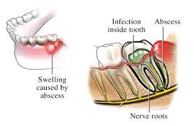 Hugedomains Com Shop For Over 300 000 Premium Domains Abscess Tooth Teeth Remedies Natural Headache Remedies