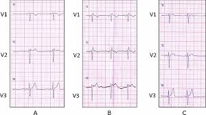 Sinus rhythm means a normal heart beat, both with respect to the heart rate and rhythm. A Standard 12 Lead Ecg 4th Ics Leads V1 V3 Sinus Rhythm Heart Download Scientific Diagram