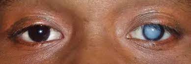 How do you get blind eye pro in mw3? What Causes The Milkiness In The Eyes Of Blind People Quora