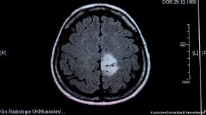 Sometimes, people with a brain tumor do not have any of these changes. Brain Tumors In Children When All That Matters Is Now Science In Depth Reporting On Science And Technology Dw 08 06 2020