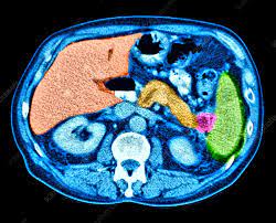 Maybe you would like to learn more about one of these? Pancreatic Cancer Ct Scan Stock Image C037 8292 Science Photo Library