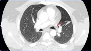 A hamartoma is a mostly benign, local malformation of cells that resembles a neoplasm of local tissue but is usually due to an overgrowth of multiple aberrant cells, with a basis in a systemic genetic condition, rather than a growth descended from a single mutated cell (monoclonality). Cureus Endobronchial Hamartoma As A Rare Cause Of Recurrent Respiratory Symptoms Case Report And Literature Review