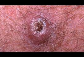 Cancer occurs when cells begin to randomly divide and grow out of control. Merkel Cell Carcinoma Picture Image On Medicinenet Com