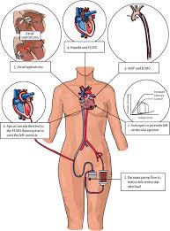 Temporary Circulatory Support For Cardiogenic Shock Sciencedirect
