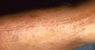 Poison Ivy Oak And Sumac Picture Gallery For Identifying Poison Oak Rash Pictures Poison Ivy Pictures Poison Oak Rash
