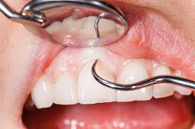 Encias Blancas Causas Y Prevencion Clinica Dental Bayo Martin