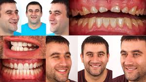 Lon clarke offers cosmetic, general, and restorative dentistry treatments to patients from barbados, trinidad, grenada, and other caribbean islands to . Restoration In Aesthetic Dentistry Functional And Prosthetic Rehabilitation