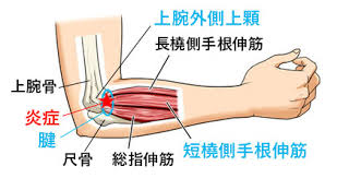 テニス肘とは -vol.1- - 巣鴨整形外科リハビリテーションクリニック