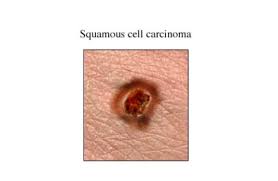 Metastasis is the spread of cancer cells to new areas of the body, often by way of the lymph system or bloodstream. Squamous Cell Carcinoma Uva Health