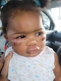 BABY-ON-BABY CRIME?: Parents of toddler injured at school still seeking  answers one week later