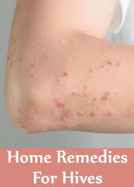 Effective Home Remedy For Hives Health Gadgetsng