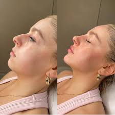 LIPS & CHIN ✨ By Bethany. Want these kind of natural tweaks? We're the  injectors for you🙋🏻‍♀️ We specialise in facial harmony, so if that's what  you're after, natural tweaks… we got