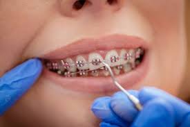 Ceramic braces blend in with your natural teeth and are not visible. Cost Of Orthodontic Treatment Cost Of Braces Orthodontist In Buffalo Ny