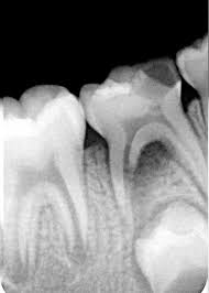 Baby Teeth Anatomy Seymour Dental Dedicated Personal Care