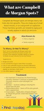 Learn about the causes and treatments here. Campbell De Morgan Spots Or Cherry Angiomas Are They Serious