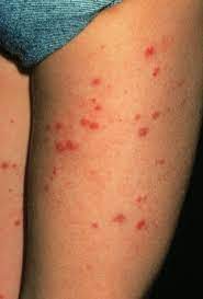 Purpura refers to the purple discoloring of the skin, as with a bruise. Immunoglobulin A Associated Vasculitis Igav Musculoskeletal And Connective Tissue Disorders Msd Manual Professional Edition