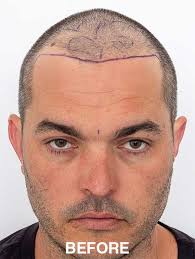 Changing lives one hairline at a time