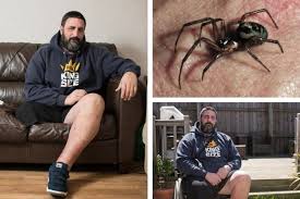 That said, the venom of a black widow spider—known for its distinctive to administer first aid for a black widow spider bite, follow these steps: Spider Bite Horror Sees Dad S Leg Amputated After False Widow Bite Glasgow Times