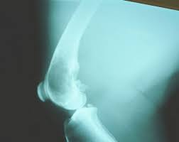 Signs of Osteosarcoma (Bone Cancer) in Dogs - HubPages