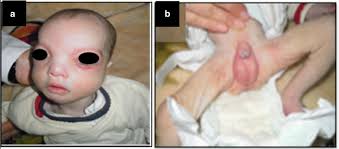 Disorders of sex development in Wolf–Hirschhorn syndrome: a  genotype–phenotype correlation and MSX1 as candidate gene