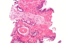 The pancreas is located behind the stomach, so having pancreatic cancer doesn't involve a palpable mass that you can feel. Novartis Prostate Cancer Drug Gets Fda Breakthrough Designation