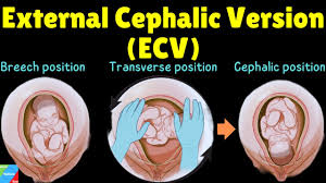 Image result for External Cephalic Version