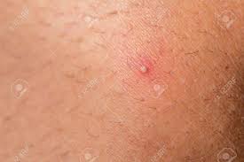 Why do ingrown hairs become such an issue? Ingrown Hair Stock Photo Picture And Royalty Free Image Image 18007664