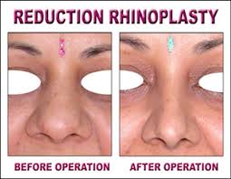 Reduction Rhinoplasty Large Or Heavy Nose Needs Reduction In Size Usually Bony And Or Cartilaginous Structure N Rhinoplasty Surgery Rhinoplasty Nose Surgery