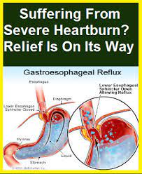 Natural Heartburn Relief Severe Heartburn Relief Severe Heartburn Severe Heartburn Relief Heartburn Relief Instant