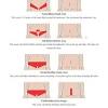 Women, and now, even men, prefer to go in for fair skinned persons the alexandrite laser is usually regarded as the best laser for hair removal. 1