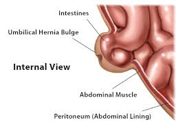 Image result for stomach hernia symptoms