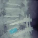 Postoperative lateral X-ray of the lumbar spine. The OLIF ...