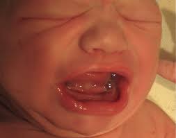 Tongue tie resources