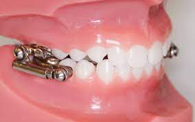 All About The Fixed Functional Appliance Or Herbst Appliance Bronsky Orthodontics Nyc