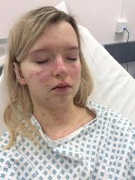 CALLING SEPSIS SURVIVORS We're...