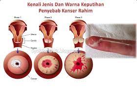 Selain keputihan normal ada juga keputihan yang terjadi akibat infeksi jamur atau bakteri. Deina Info On Twitter Simptom Keputihan Yg Disebabkan Kanser Apabila Vagina Mengeluarkan Cecair Berbau Yg Luar Biasa Selain Itu Tanda Tanda Lain Adalah Masalah Keputihan Atau Lelehan Tersebut Akan Menjadi Lebih Banyak Pucat