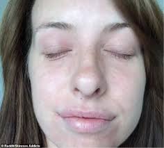 Coconut oil, being a triglyceride of lauric acid (principal fatty acid), has a high affinity for hair proteins and, because of its low molecular weight and straight linear chain, is able to penetrate inside the hair shaft. Vitamin D Eczema Reddit