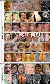De Novo Variants In Med12 Cause X Linked Syndromic Neurodevelopmental Disorders In 18 Females Genetics In Medicine