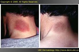 Image result for Fixed Drug Eruption