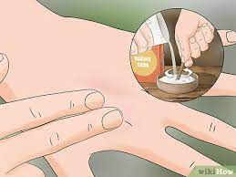 12,862 views, added to favorites 411 times. How To Treat A Caterpillar Sting 11 Steps With Pictures