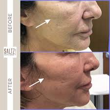 This beautiful patient is 72 years young and looks fabulous. She was  thrilled with her results and feels refreshed and youthful. Injecting  filler strategically in these areas to restore volume loss we